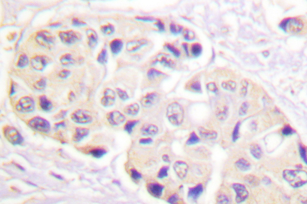 Immunohistochemistry (IHC) analysis of p-HSP90 beta (S254) pAb in paraffin-embedded human breast cancer tissue.