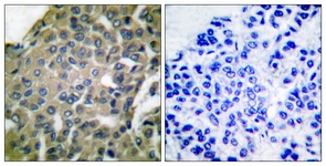 IHC of paraffin-embedded human breast carcinoma tissue, using GRP94 Antibody. The picture on the right is treated with the synthesized peptide.