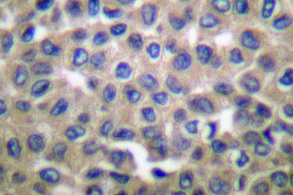 IHC of Endoplasmin (E790) pAb in paraffin-embedded human breast carcinoma tissue.