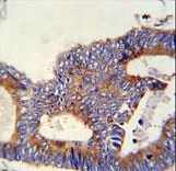 HSPA5 Antibody immunohistochemistry of formalin-fixed and paraffin-embedded human colon carcinoma followed by peroxidase-conjugated secondary antibody and DAB staining.