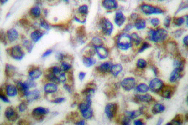 IHC of GRP75/HSPA9 (S664) pAb in paraffin-embedded human breast carcinoma tissue.