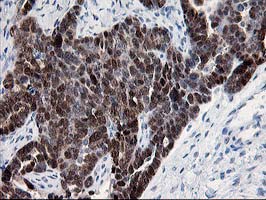 IHC of paraffin-embedded Adenocarcinoma of Human ovary tissue using anti-HSPBP1 mouse monoclonal antibody.