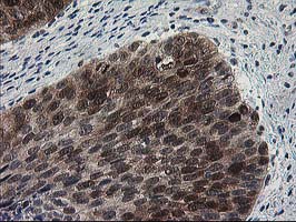 IHC of paraffin-embedded Carcinoma of Human bladder tissue using anti-HSPBP1 mouse monoclonal antibody.