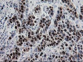 IHC of paraffin-embedded Carcinoma of Human lung tissue using anti-HSPBP1 mouse monoclonal antibody.