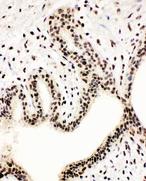 NFE2L2 / NRF2 antibody. IHC(P): Human Breast Cancer Tissue.