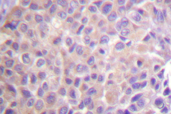 IHC of IB- (D17) pAb in paraffin-embedded human breast carcinoma tissue.