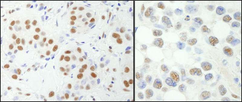 Detection of Human and Mouse NF-YA by Immunohistochemistry. Sample: FFPE section of human breast carcinoma (left) and mouse hybridoma tumor (right). Antibody: Affinity purified rabbit anti-NF-YA used at a dilution of 1:200 (1 ug/ml). Detection: DAB.