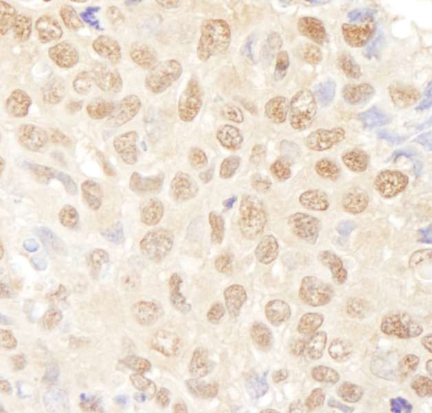 Detection of Human NF-YA by Immunohistochemistry. Sample: FFPE section of human non-small cell lung cancer. Antibody: Affinity purified rabbit anti-NF-YA used at a dilution of 1:1000 (1 ug/ml). Detection: DAB.