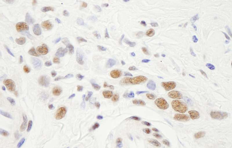 Detection of Human NF-YA by Immunohistochemistry. Sample: FFPE section of human Linitis Plastica stomach cancer. Antibody: Affinity purified rabbit anti-NF-YA used at a dilution of 1:250.