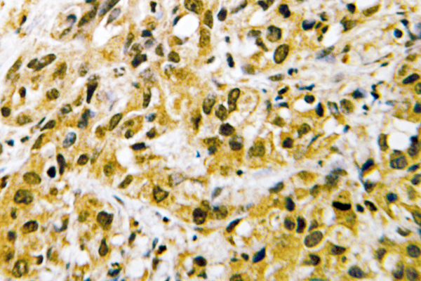 IHC of NF-YC (W85) pAb in paraffin-embedded human liver carcinoma tissue.