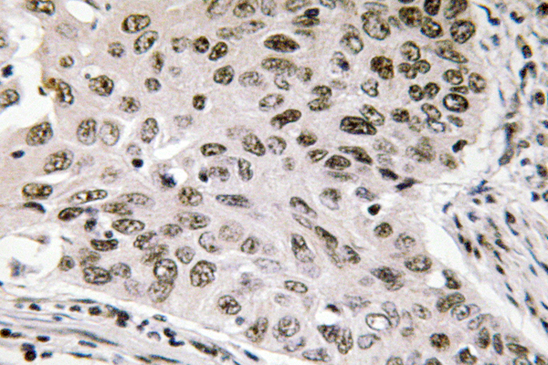 IHC of NIFK (D229) pAb in paraffin-embedded human lung carcinoma tissue.