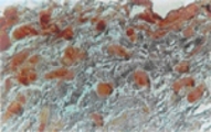 NIFK KI67ip -immunostaining in adipocytes of human Carcinomatous Breast tissue using antibody at 1:500 dilution.