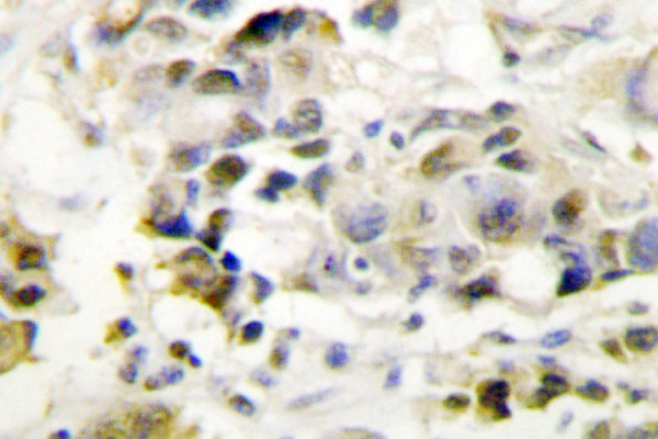 IHC of TRAP220 (P697) pAb in paraffin-embedded human breast carcinoma tissue.