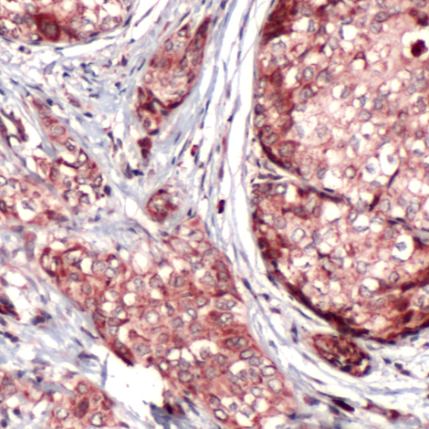 Immunohistochemistry of Human Breast Carcinoma stained with anti-Bnip3L antibody