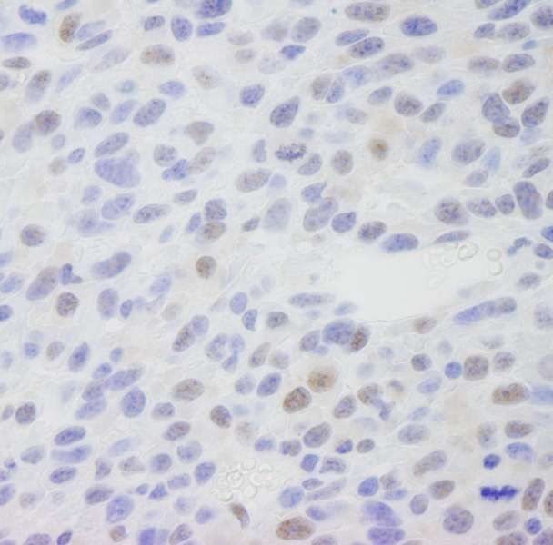 Detection of Mouse CRSP1(TRAP220) by Immunohistochemistry. Sample: FFPE section of mouse squamous cell carcinoma. Antibody: Affinity purified rabbit anti-CRSP1(TRAP220) used at a dilution of 1:250.