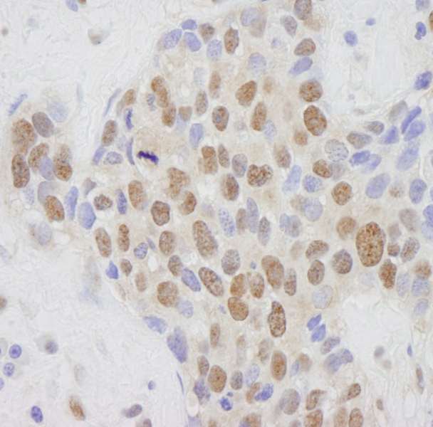 Detection of Human CRSP1(TRAP220) by Immunohistochemistry. Sample: FFPE section of human breast tumor. Antibody: Affinity purified rabbit anti-CRSP1(TRAP220) used at a dilution of 1:250.