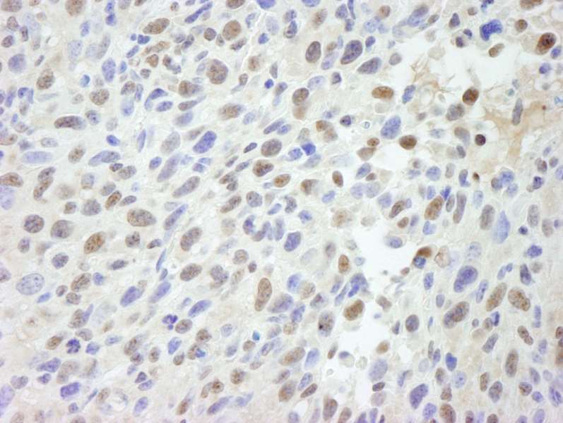 Detection of Mouse MED12 by Immunohistochemistry. Sample: FFPE section of mouse squamous cell carcinoma. Antibody: Affinity purified rabbit anti-MED12 used at a dilution of 1:250.