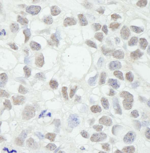 Detection of Human MED12 by Immunohistochemistry. Sample: FFPE section of human breast adenocarcinoma. Antibody: Affinity purified rabbit anti-MED12 used at a dilution of 1:250.