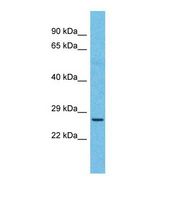 Western blot of Human Esophagus Tumor. NKX6-2 antibody dilution 1.0 ug/ml.