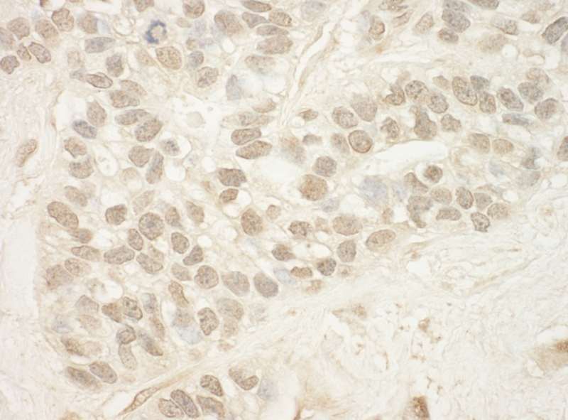 Detection of Human MED15 by Immunohistochemistry. Sample: FFPE section of human breast carcinoma. Antibody: Affinity purified rabbit anti-MED15 used at a dilution of 1:200 (1 Detection: DAB.