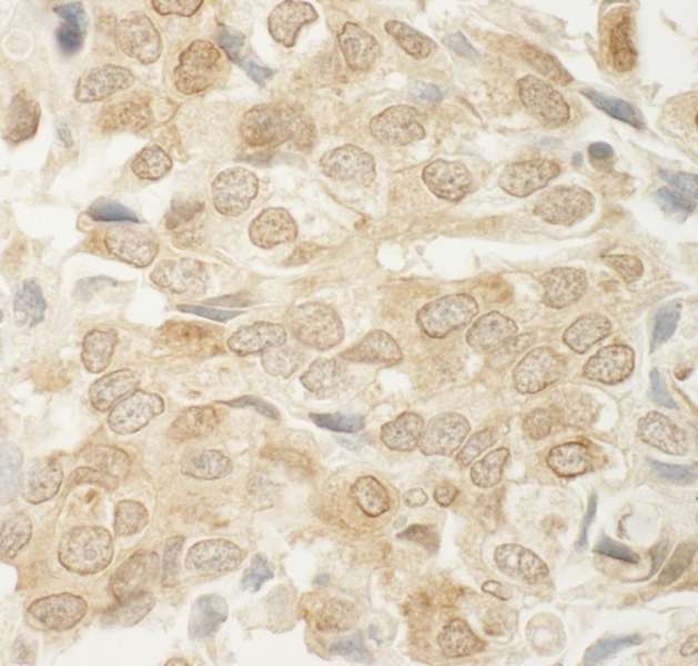 Detection of Human MED15 by Immunohistochemistry. Sample: FFPE section of human breast carcinoma. Antibody: Affinity purified rabbit anti-MED15 used at a dilution of 1:250.