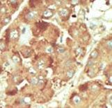 Formalin-fixed and paraffin-embedded human cancer tissue reacted with the primary antibody, which was peroxidase-conjugated to the secondary antibody, followed by DAB staining. This data demonstrates the use of this antibody for immunohistochemistry; clinical relevance has not been evaluated. BC = breast carcinoma; HC = hepatocarcinoma.