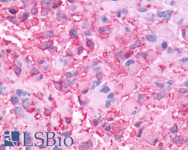 Anti-NMBR antibody IHC of human Brain, Glioblastoma. Immunohistochemistry of formalin-fixed, paraffin-embedded tissue after heat-induced antigen retrieval.
