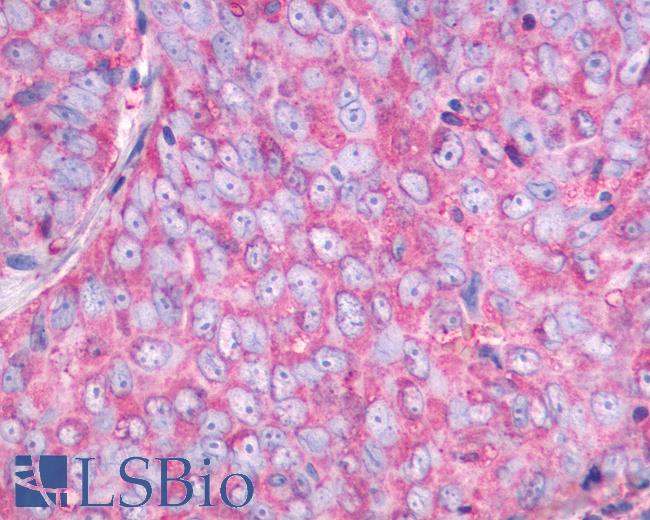 Anti-NMBR antibody IHC of human Ovary, Carcinoma. Immunohistochemistry of formalin-fixed, paraffin-embedded tissue after heat-induced antigen retrieval.