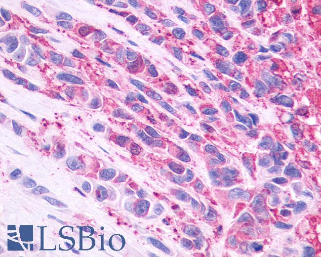 Anti-NMBR antibody IHC of human Skin, Melanoma. Immunohistochemistry of formalin-fixed, paraffin-embedded tissue after heat-induced antigen retrieval.