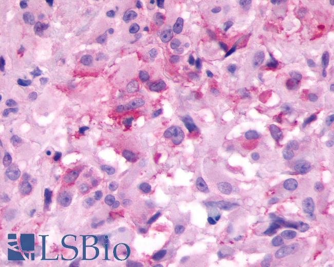 Anti-NMBR antibody IHC of human brain, glioblastoma. Immunohistochemistry of formalin-fixed, paraffin-embedded tissue after heat-induced antigen retrieval.