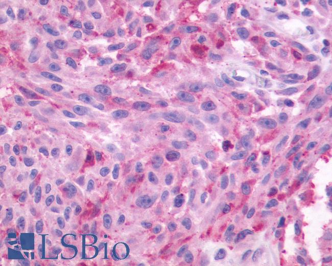 Anti-NMBR antibody IHC of human Skin, Melanoma. Immunohistochemistry of formalin-fixed, paraffin-embedded tissue after heat-induced antigen retrieval.