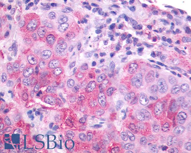 Anti-NMBR antibody IHC of human lung, carcinoma. Immunohistochemistry of formalin-fixed, paraffin-embedded tissue after heat-induced antigen retrieval. Antibody LS-A825 dilution 16 ug/ml.