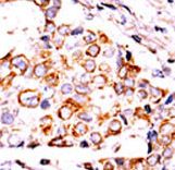 Formalin-fixed and paraffin-embedded human cancer tissue reacted with the primary antibody, which was peroxidase-conjugated to the secondary antibody, followed by DAB staining. This data demonstrates the use of this antibody for immunohistochemistry; clinical relevance has not been evaluated. BC = breast carcinoma; HC = hepatocarcinoma.