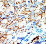 Formalin-fixed and paraffin-embedded human cancer tissue reacted with the primary antibody, which was peroxidase-conjugated to the secondary antibody, followed by AEC staining. This data demonstrates the use of this antibody for immunohistochemistry; clinical relevance has not been evaluated. BC = breast carcinoma; HC = hepatocarcinoma.
