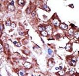 Formalin-fixed and paraffin-embedded human cancer tissue reacted with the primary antibody, which was peroxidase-conjugated to the secondary antibody, followed by AEC staining. This data demonstrates the use of this antibody for immunohistochemistry; clinical relevance has not been evaluated. BC = breast carcinoma; HC = hepatocarcinoma.