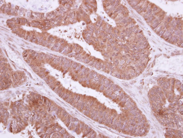 IHC of paraffin-embedded Colon ca, using TXNDC6 antibody at 1:500 dilution.