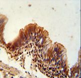 TXNDC6 antibody immunohistochemistry of formalin-fixed and paraffin-embedded human lung carcinoma followed by peroxidase-conjugated secondary antibody and DAB staining.