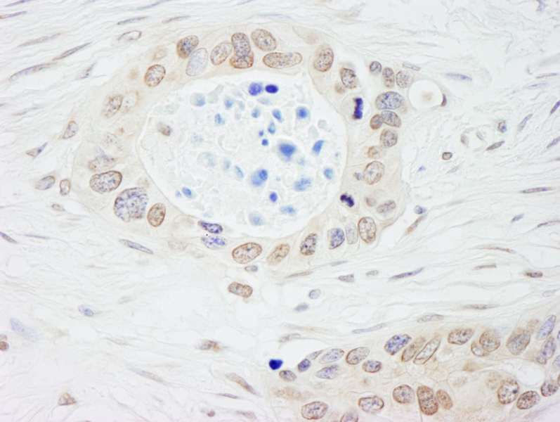 Detection of Human NMI by Immunohistochemistry. Sample: FFPE section of human ovarian carcinoma. Antibody: Affinity purified rabbit anti-NMI used at a dilution of 1:5000 (0.2 ug/ml). Detection: DAB.