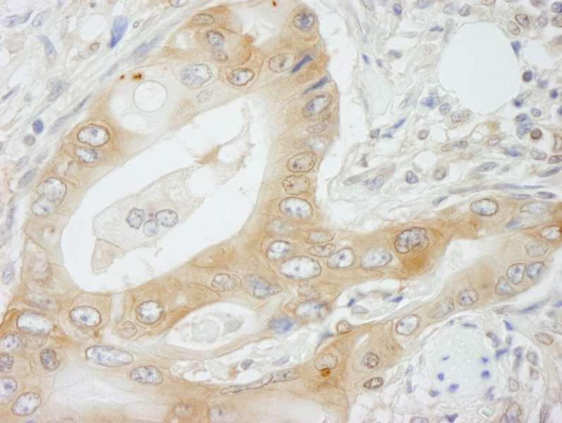 Detection of Human NMI by Immunohistochemistry. Sample: FFPE section of human colon adenocarcinoma. Antibody: Affinity purified rabbit anti-NMI used at a dilution of 1:250.