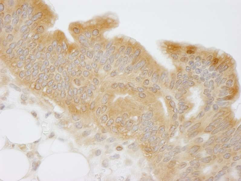 Detection of Human NMI by Immunohistochemistry. Sample: FFPE section of human mucinous ovarian carcinoma. Antibody: Affinity purified rabbit anti-NMI used at a dilution of 1:250.