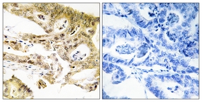 IHC of paraffin-embedded human colon carcinoma tissue, using MED23 Antibody. The picture on the right is treated with the synthesized peptide.