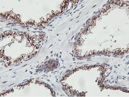 IHC of paraffin-embedded Carcinoma of Human prostate tissue using anti-NMT2 mouse monoclonal antibody.