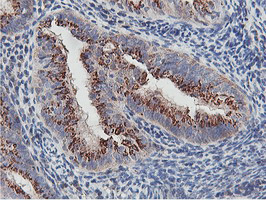 IHC of paraffin-embedded Adenocarcinoma of Human endometrium tissue using anti-NMT2 mouse monoclonal antibody.
