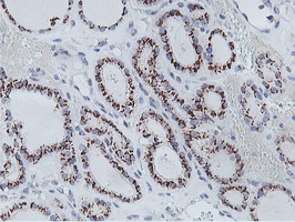 IHC of paraffin-embedded Carcinoma of Human thyroid tissue using anti-NMT2 mouse monoclonal antibody.
