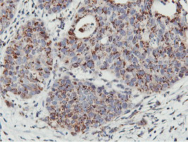 IHC of paraffin-embedded Carcinoma of Human lung tissue using anti-NMT2 mouse monoclonal antibody.