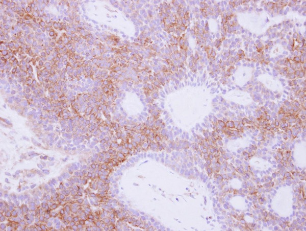 IHC of paraffin-embedded Lung carcinoma, using NMUR1 antibody at 1:250 dilution.