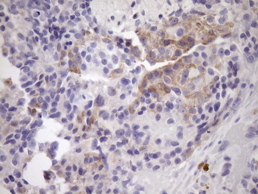 IHC of paraffin-embedded Adenocarcinoma of Human breast tissue using anti-NOBOX mouse monoclonal antibody. (Heat-induced epitope retrieval by Tris-EDTA, pH8.0)(1:150).
