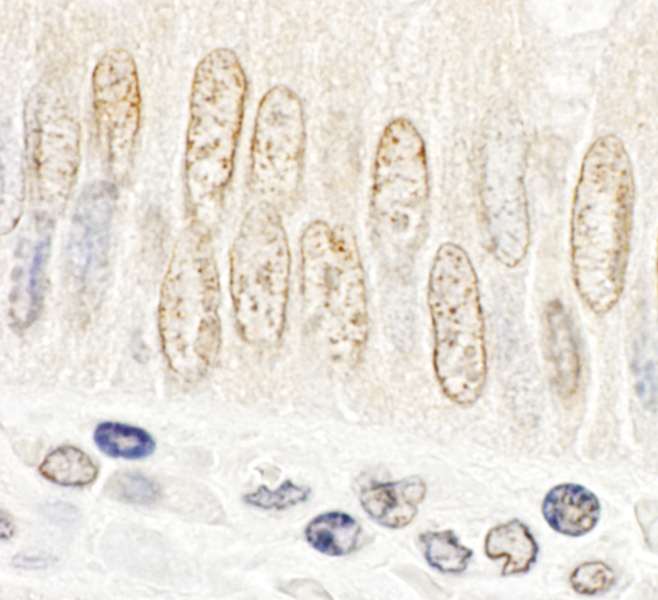 Detection of Human FAD24 by Immunohistochemistry. Sample: FFPE section of human colon carcinoma. Antibody: Affinity purified rabbit anti-FAD24 used at a dilution of 1:1000 (1 Detection: DAB.