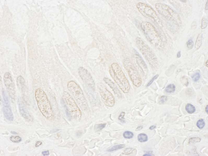 Detection of Human FAD24 by Immunohistochemistry. Sample: FFPE section of human colon carcinoma. Antibody: Affinity purified rabbit anti-FAD24 used at a dilution of 1:250.