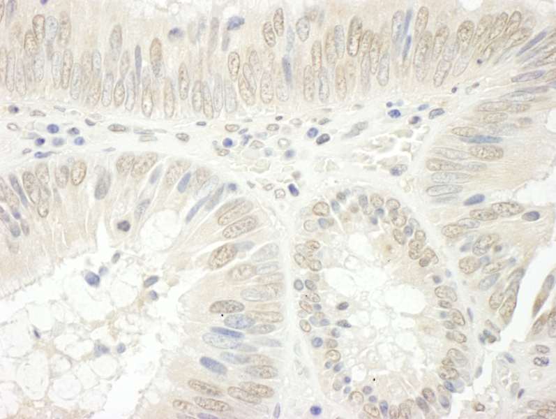 Detection of Human FAD24 by Immunohistochemistry. Sample: FFPE section of human colon carcinoma. Antibody: Affinity purified rabbit anti-FAD24 used at a dilution of 1:250.